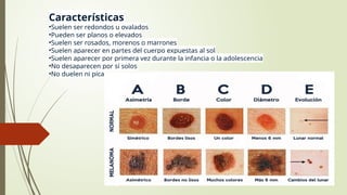 Todo sobre lunares, Verrugas y acrocordoneses | PPTX