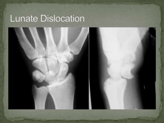  LUNATE DISLOCATION