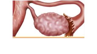 Cambios en el Ovario
 