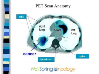Pet Scan Structure lung-090803151811-phpapp01.ppt lung carcinoma | PPT
