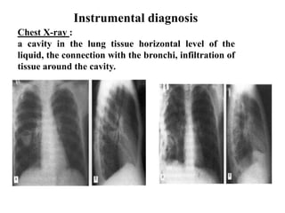 Instrumental diagnosis
Chest X-ray :
a cavity in the lung tissue horizontal level of the
liquid, the connection with the bronchi, infiltration of
tissue around the cavity.
 