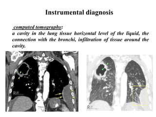 Instrumental diagnosis
computed tomography:
a cavity in the lung tissue horizontal level of the liquid, the
connection with the bronchi, infiltration of tissue around the
cavity.
 
