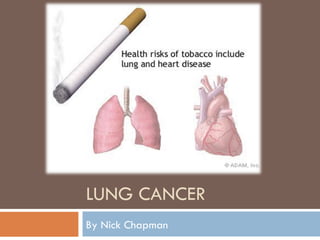 LUNG CANCER By Nick Chapman 