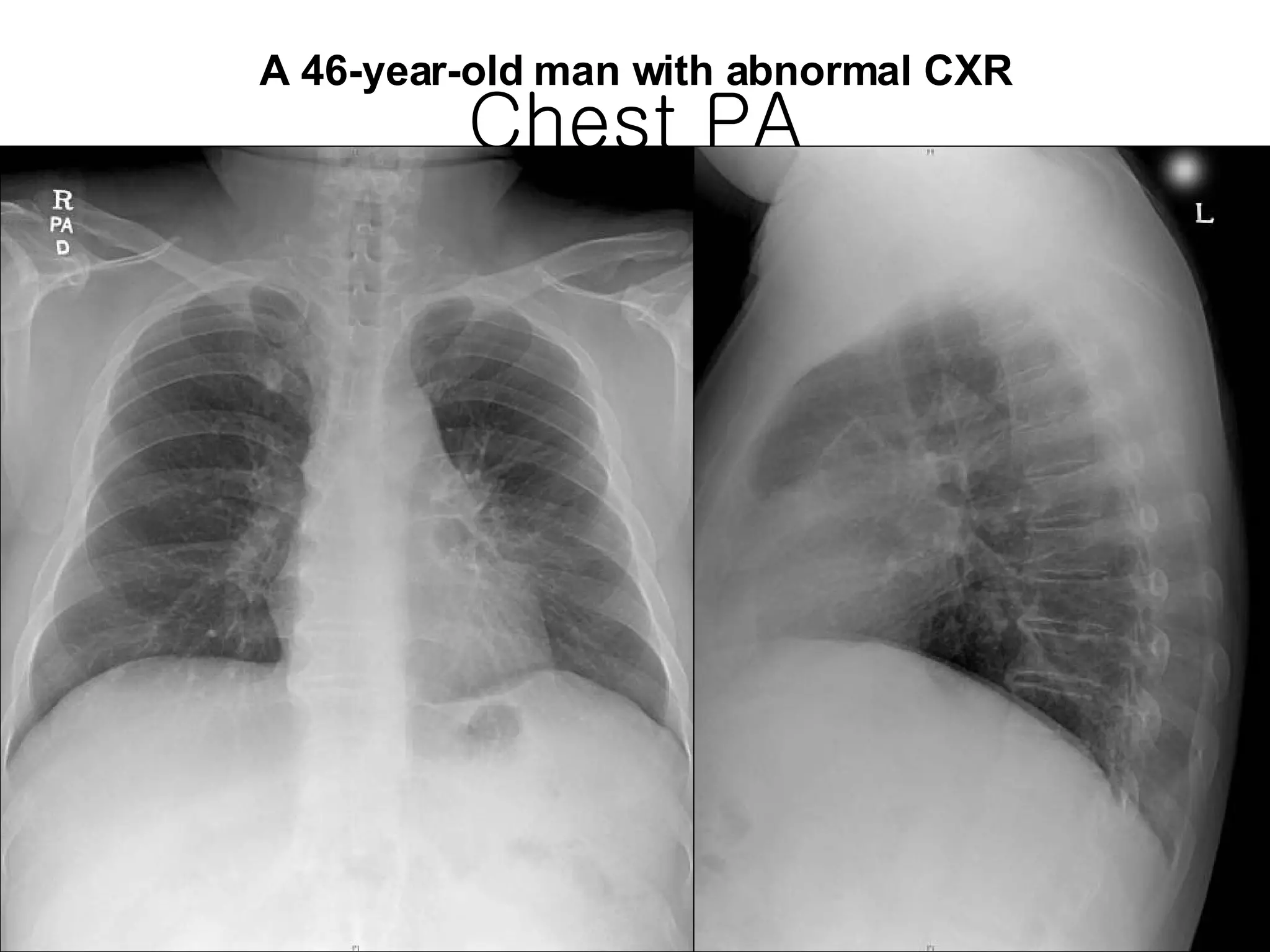 lung cancer squamous cell carcinoma | PPS