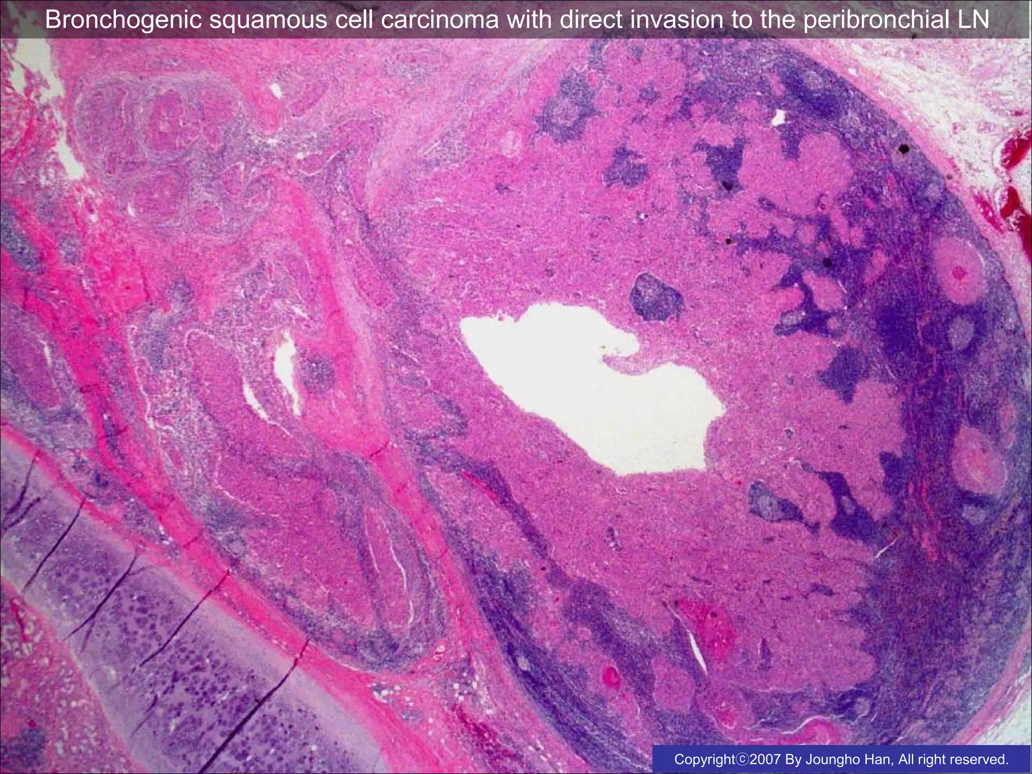 lung cancer squamous cell carcinoma | PPS