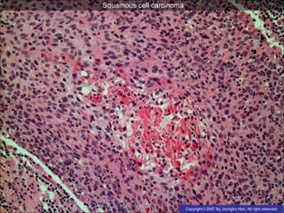 lung cancer squamous cell carcinoma | PPS