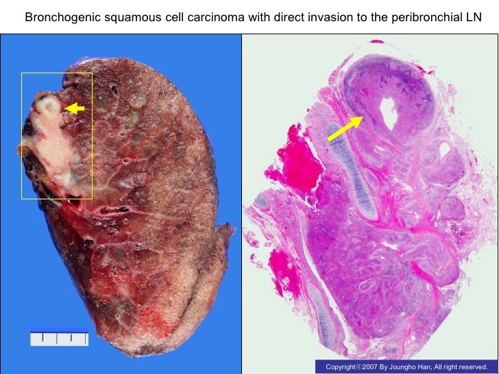 lung cancer squamous cell carcinoma