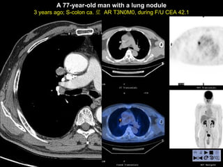 CT and PET CT A 77-year-old man with a lung nodule 3 years ago; S-colon ca. 로  AR T3N0M0, during F/U CEA 42.1 