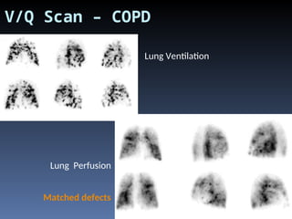 Puulmonary scan details imaging elaborted | PPT