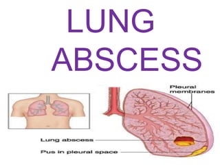 LUNG
ABSCESS
 