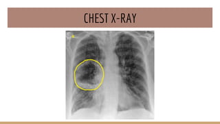 CHEST X-RAY
 