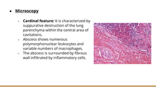 ● Microscopy
○ Cardinal feature: It is characterized by
suppurative destruction of the lung
parenchyma within the central area of
cavitations.
○ Abscess shows numerous
polymorphonuclear leukocytes and
variable numbers of macrophages.
○ The abscess is surrounded by fibrous
wall infiltrated by inflammatory cells.
 