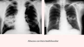 LUNG ABSCESS.pptx