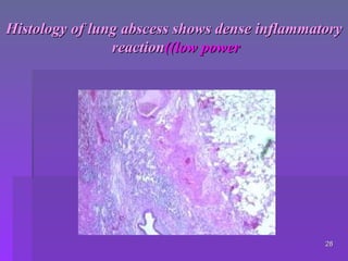 LUNG ABSCESS.pdf