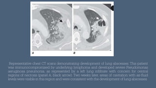 Representative chest CT scans demonstrating development of lung abscesses. This patient
was immunocompromised by underlying lymphoma and developed severe Pseudomonas
aeruginosa pneumonia, as represented by a left lung in
f
iltrate with concern for central
regions of necrosis (panel A, black arrow). Two weeks later, areas of cavitation with air-
f
luid
levels were visible in this region and were consistent with the development of lung abscesses
 
