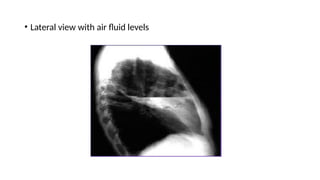 • Lateral view with air fluid levels
 