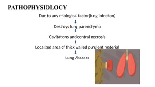 PATHOPHYSIOLOGY
Due to any etiological factor(lung infection)
Destroys lung parenchyma
Cavitations and central necrosis
Localized area of thick walled purulent material
Lung Abscess
 