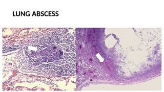 Etiology and pathogenesis of lung abscess | PPTX