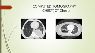 COMPUTED TOMOGRAPHY
CHEST( CT Chest)
 
