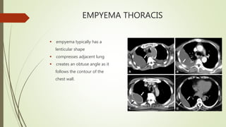 EMPYEMA THORACIS
 empyema typically has a
lenticular shape
 compresses adjacent lung
 creates an obtuse angle as it
follows the contour of the
chest wall.
 
