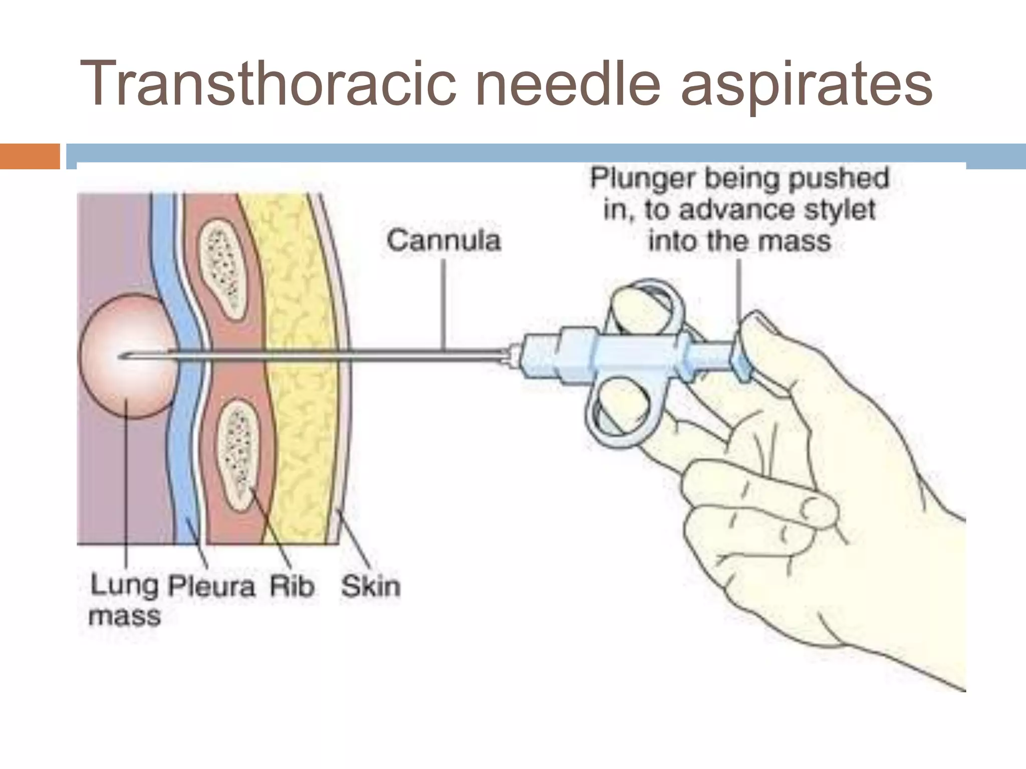 Lung abscess | PPTX