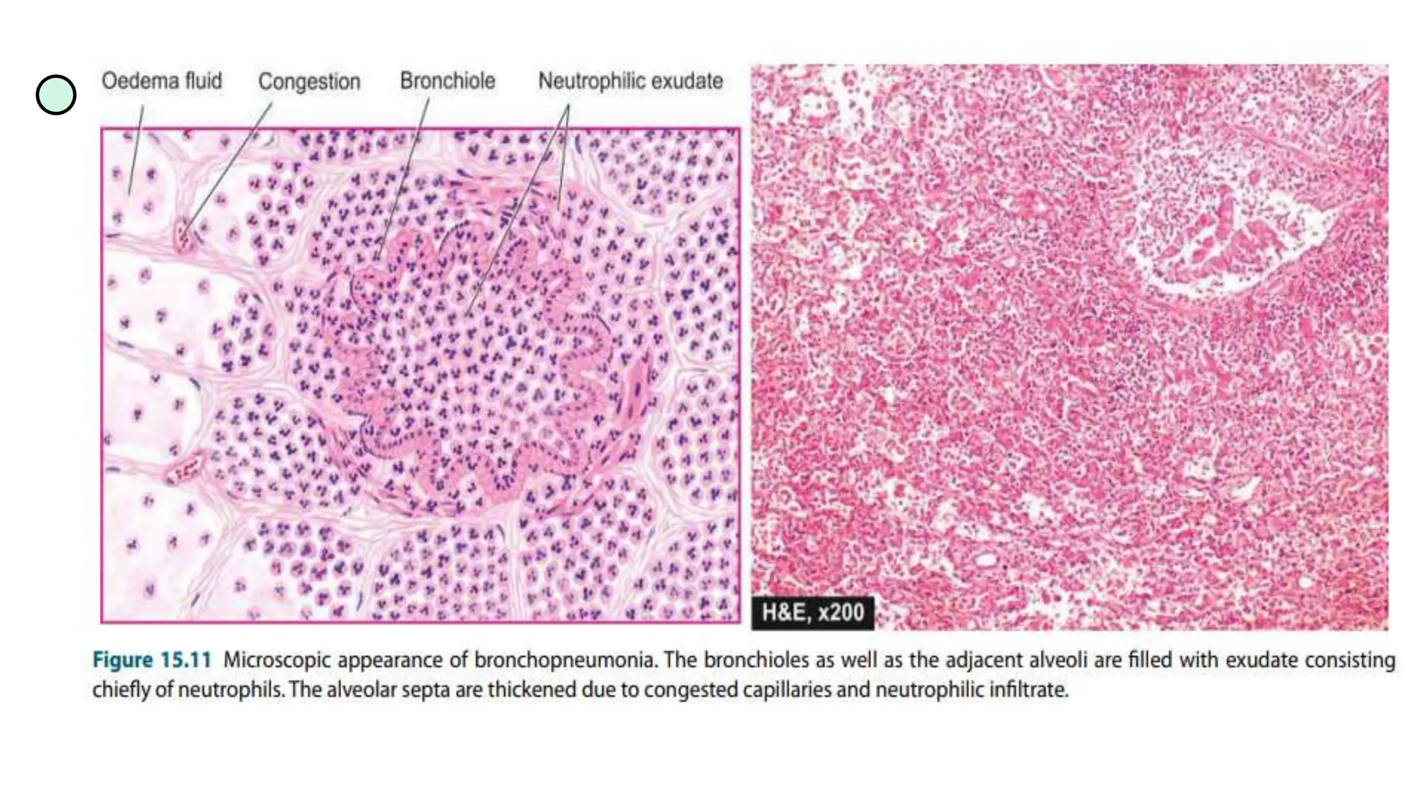 Lung Abscess and Pneumonia (Pathology) | PPTX