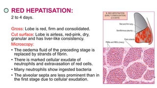 RED HEPATISATION:
2 to 4 days.
Gross: Lobe is red, firm and consolidated.
Cut surface: Lobe is airless, red-pink, dry,
granular and has liver-like consistency.
Microscopy:
• The oedema fluid of the preceding stage is
replaced by strands of fibrin.
• There is marked cellular exudate of
neutrophils and extravasation of red cells.
• Many neutrophils show ingested bacteria
• The alveolar septa are less prominent than in
the first stage due to cellular exudation.
 
