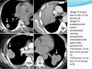 •Stage T1 tumor
due to size <3 cm
(arrow, A).
•Stage T2
endobronchial
tumor
(arrowhead)
causing
pneumonitis
restricted to the
upper lobe
(arrow) in B.
•T2a tumor >3 cm
but <5 cm (arrow,
C).
•T2b tumor >5 cm
but <7 cm (arrow
in D)
 