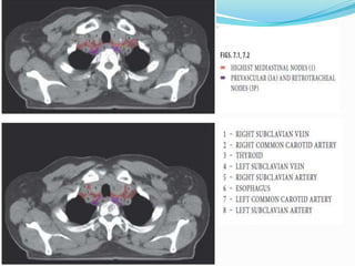 Lymph nodal stations in ca lung