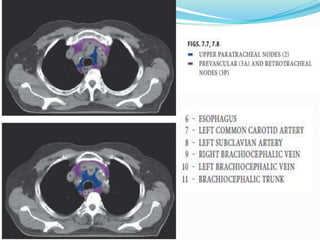 Lymph nodal stations in ca lung