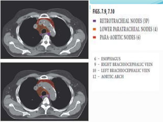 Lymph nodal stations in ca lung