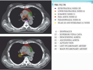 Lymph nodal stations in ca lung