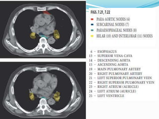 Lymph nodal stations in ca lung