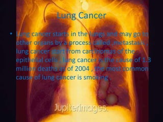 Lung Cancer
• Lung cancer starts in the lungs and may go to
  other organs by a process called ,metastasis ,
  lung cancer start from carcinomas of the
  epithelial cells , lung cancer is the cause of 1.3
  million deaths as of 2004 , the most common
  cause of lung cancer is smoking .
 