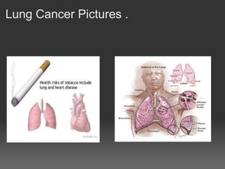 Lung Cancer Pictures .
 