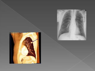 Lung cancer