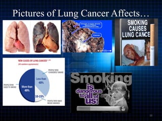 Pictures of Lung Cancer Affects…

10

 