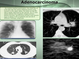 Adenocarcinoma
On routine medical examination, the chest film of
a 64-year-old man shows bilateral primary lung
tumours in the upper lobes; the lesion on the left
side is partly obscured by the clavicle. (b) CT scan
clearly defines the irregularly shaped primary
lesions (arrows). Synchronous primary lung cancers
occur in about 3-5% of patients and can be of
different histologic subgroups.

 
