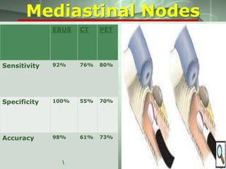 Mediastinal Nodes
EBUS

CT

PET

Sensitivity

92%

76%

80%

Specificity

100%

55%

70%

Accuracy

98%

61%

73%

.

 