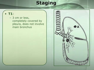 Staging
• T1:
– 3 cm or less,
completely covered by
pleura, does not involve
main bronchus

 