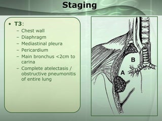 Staging
• T3:
–
–
–
–
–

Chest wall
Diaphragm
Mediastinal pleura
Pericardium
Main bronchus <2cm to
carina
– Complete atelectasis /
obstructive pneumonitis
of entire lung

 