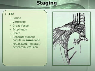 Staging
• T4:
–
–
–
–
–
–

Carina
Vertebrae
Great Vessel
Esophagus
Heart
Separate tumour
nodule in same lobe
– MALIGNANT pleural /
pericardial effusion

 