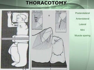 THORACOTOMY
Posterolateral

Anterolateral
Lateral
Mini
Muscle sparing

 