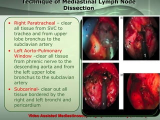 Technique of Mediastinal Lymph Node
Dissection
• Right Paratracheal – clear
all tissue from SVC to
trachea and from upper
lobe bronchus to the
subclavian artery
• Left Aorto-Pulmonary
Window –clear all tissue
from phrenic nerve to the
descending aorta and from
the left upper lobe
bronchus to the subclavian
artery
• Subcarinal- clear out all
tissue bordered by the
right and left bronchi and
pericardium
Video Assisted Mediastinoscopic Lymphadenectomy (VAMLA)

 