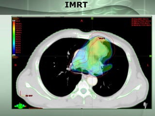 IMRT

 