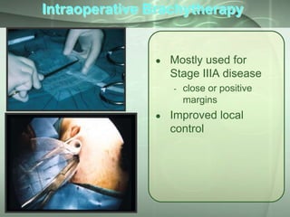 Intraoperative Brachytherapy

●

Mostly used for
Stage IIIA disease
-

●

close or positive
margins

Improved local
control

 