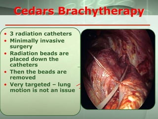Cedars Brachytherapy
• 3 radiation catheters
• Minimally invasive
surgery
• Radiation beads are
placed down the
catheters
• Then the beads are
removed
• Very targeted – lung
motion is not an issue
Catheters for
radiation
beads

 