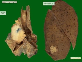 Adeno Ca.

SCC

 