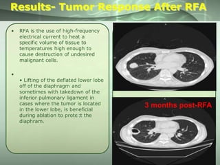 Results- Tumor Response After RFA
•

•

RFA is the use of high-frequency
electrical current to heat a
specific volume of tissue to
temperatures high enough to
cause destruction of undesired
malignant cells.

• Lifting of the deflated lower lobe
off of the diaphragm and
sometimes with takedown of the
inferior pulmonary ligament in
cases where the tumor is located
in the lower lobe, is beneficial
during ablation to protect the
1
diaphram.

3 months post-RFA

 
