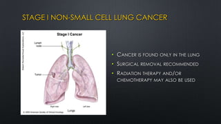 STAGE I NON-SMALL CELL LUNG CANCER
• CANCER IS FOUND ONLY IN THE LUNG
• SURGICAL REMOVAL RECOMMENDED
• RADIATION THERAPY AND/OR
CHEMOTHERAPY MAY ALSO BE USED
 